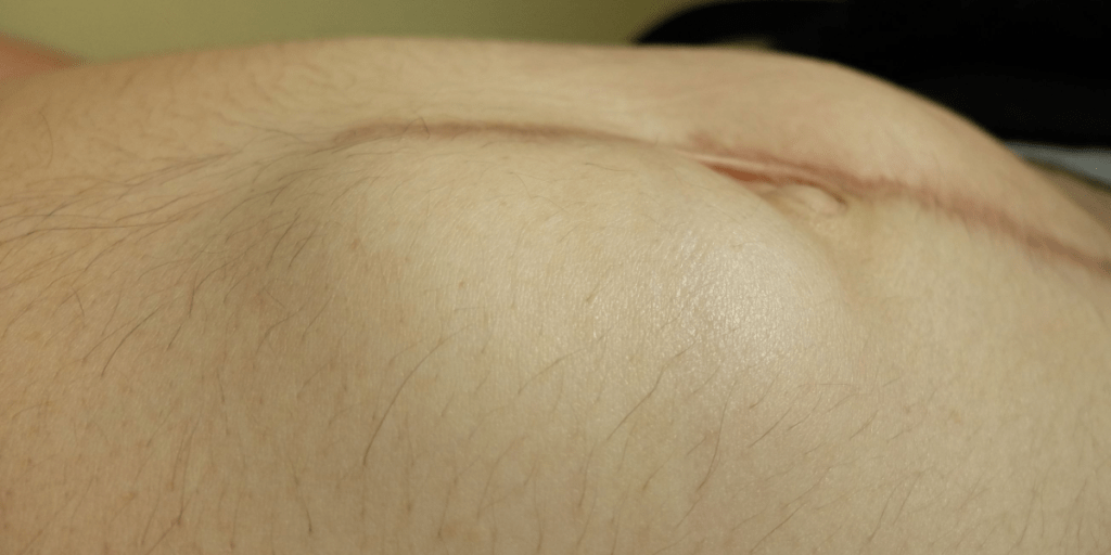 hernia incisional